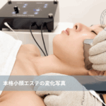大名・赤坂・天神のリフトアップ専門サロンLyonの小顔矯正フェイシャル