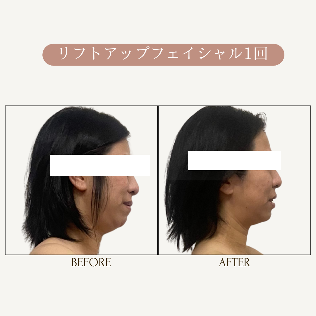 リフトアップフェイシャル、顎のたるみ1回結果写真、ビフォーアフター写真｜リフトアップ専門店リヨン「大名/赤坂/天神