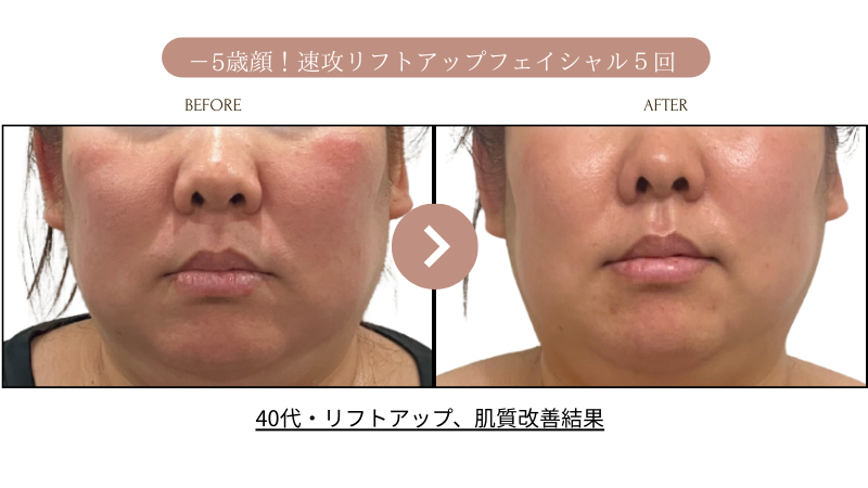 リフトアップフェイシャル、リフトアップ5回結果写真、ビフォーアフター写真｜リフトアップ専門店リヨン「大名/赤坂/天神」01 