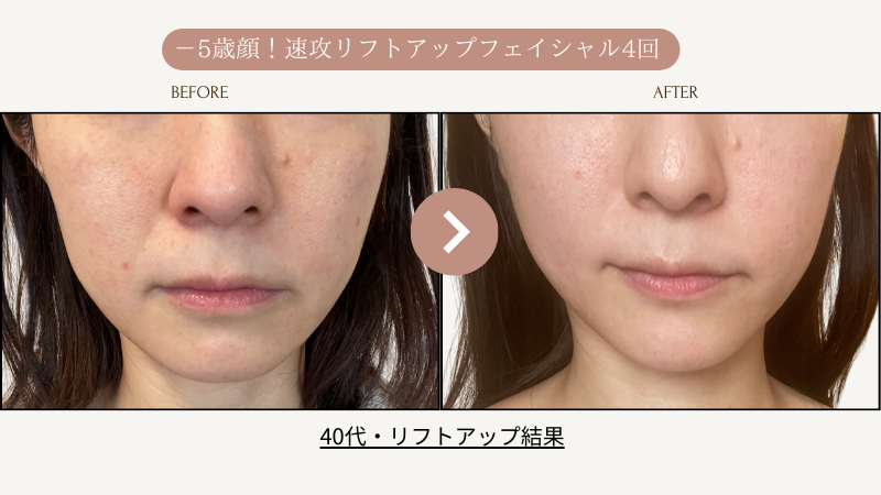 リフトアップフェイシャル、リフトアップ5回結果写真、ビフォーアフター写真｜リフトアップ専門店リヨン「大名/赤坂/天神」02
