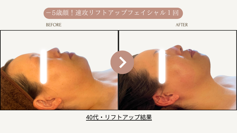 リフトアップフェイシャル、フェイスライン1回結果写真、ビフォーアフター写真04｜リフトアップ専門店リヨン「大名/赤坂/天神」05