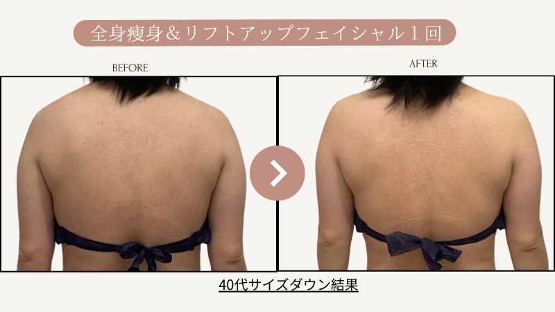リフトアップフェイシャル、全身痩身1回サイズダウン結果写真09、ビフォーアフター写真｜リフトアップ専門店リヨン「大名/赤坂/天神08