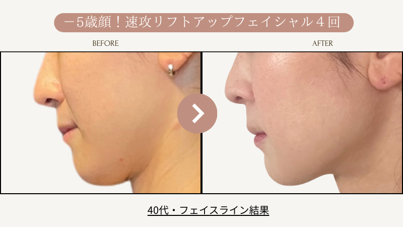 リフトアップフェイシャル、フェイスライン結果写真、ビフォーアフター写真｜リフトアップ専門店リヨン「大名/赤坂/天神」04