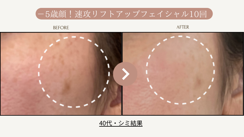 リフトアップフェイシャル、フェイスライン1回結果写真、ビフォーアフター写真04｜リフトアップ専門店リヨン「大名/赤坂/天神」06