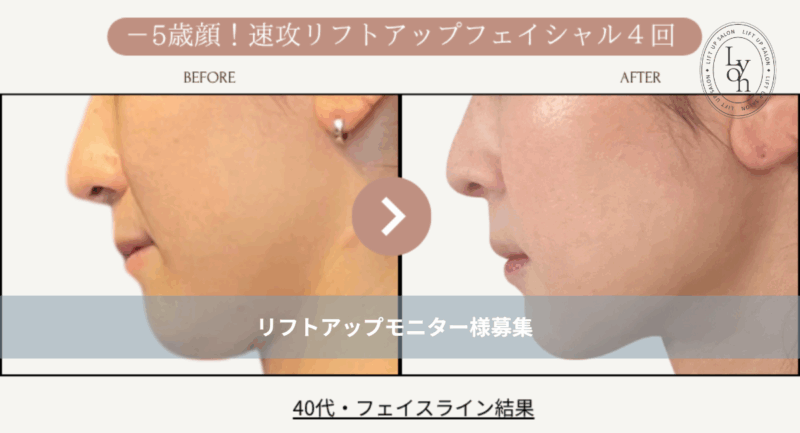 リフトアップフェイシャル、フェイスライン結果写真、ビフォーアフター写真｜リフトアップ専門店リヨン「大名/赤坂/天神」モニターキャンペーン画像