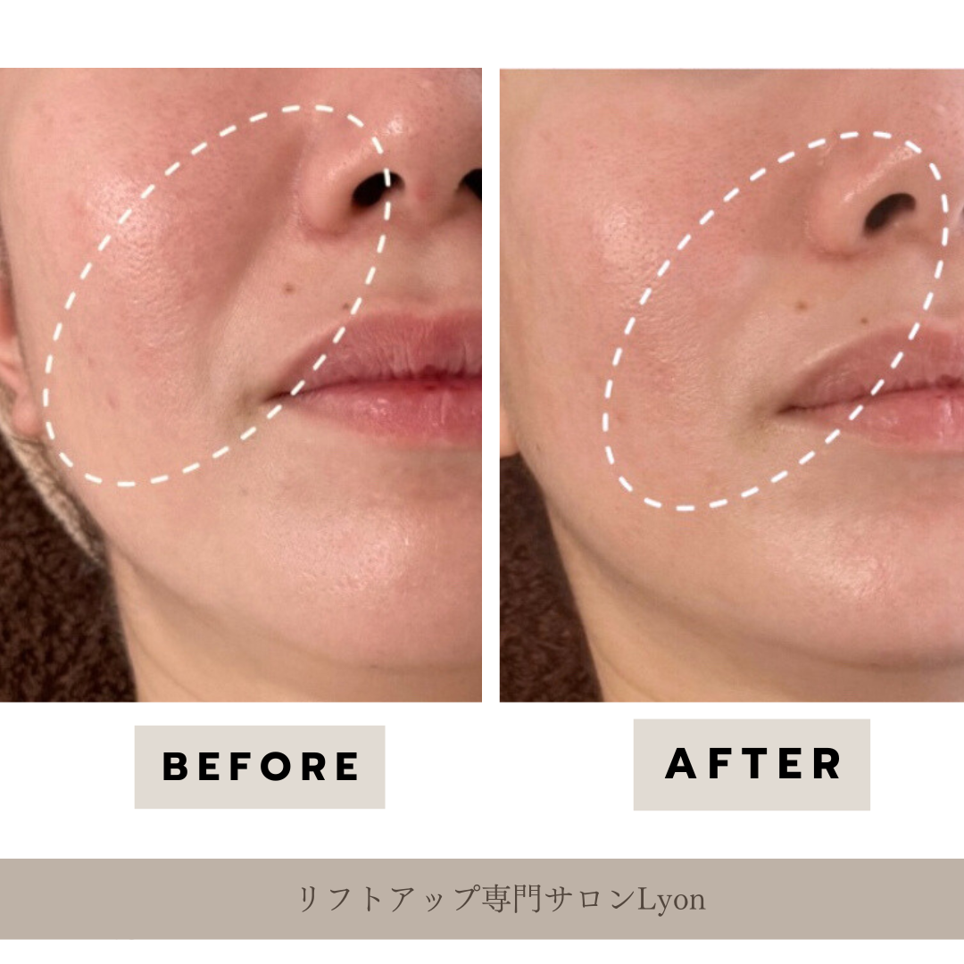 リフトアップフェイシャル、フェイスライン結果写真、ビフォーアフター写真|リフトアップ専門店リヨン「大名/赤坂/天神」ビフォーアフター写真