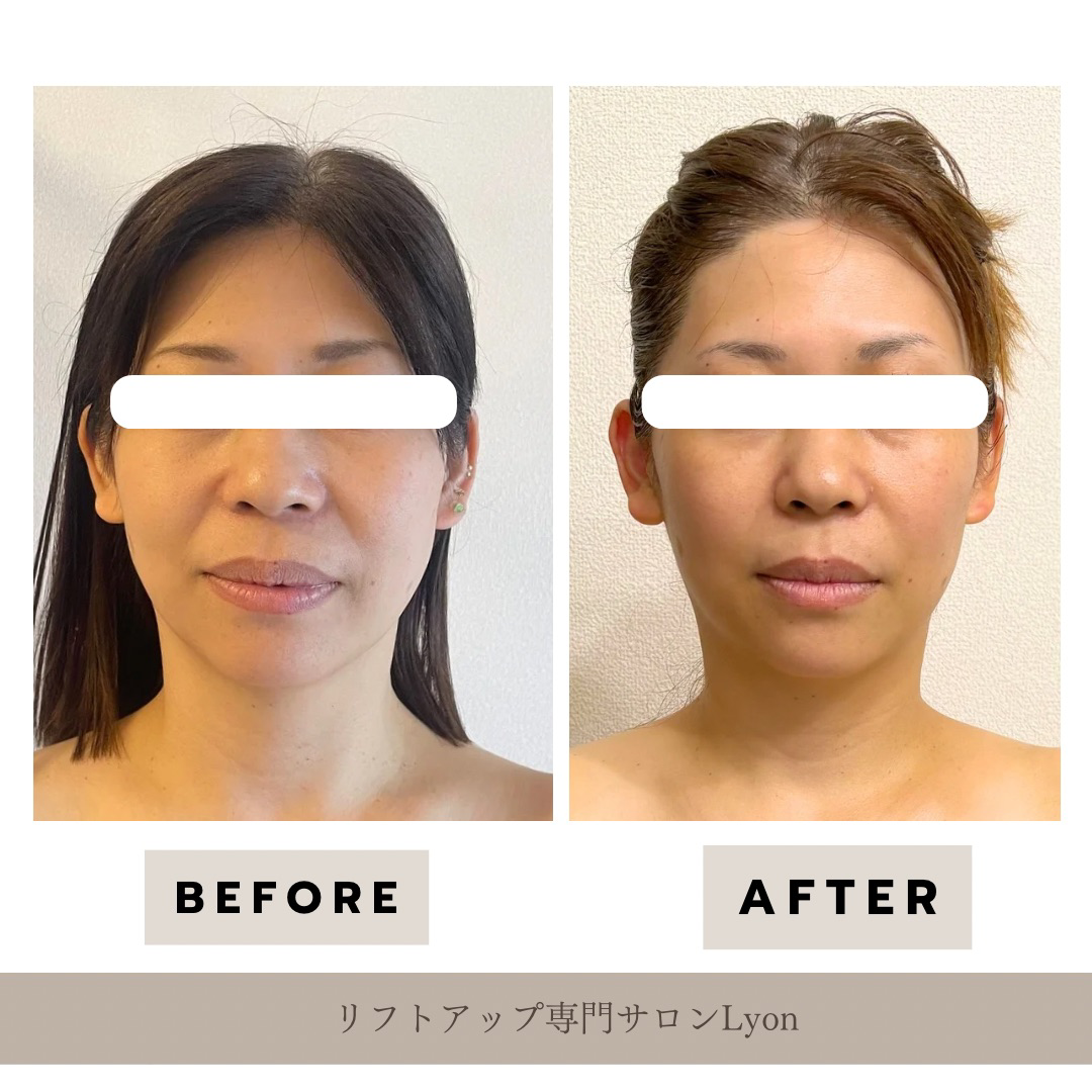 大名・赤坂のリフトアップ専門サロンLyonのブログ/小顔矯正・エステ/症例画像