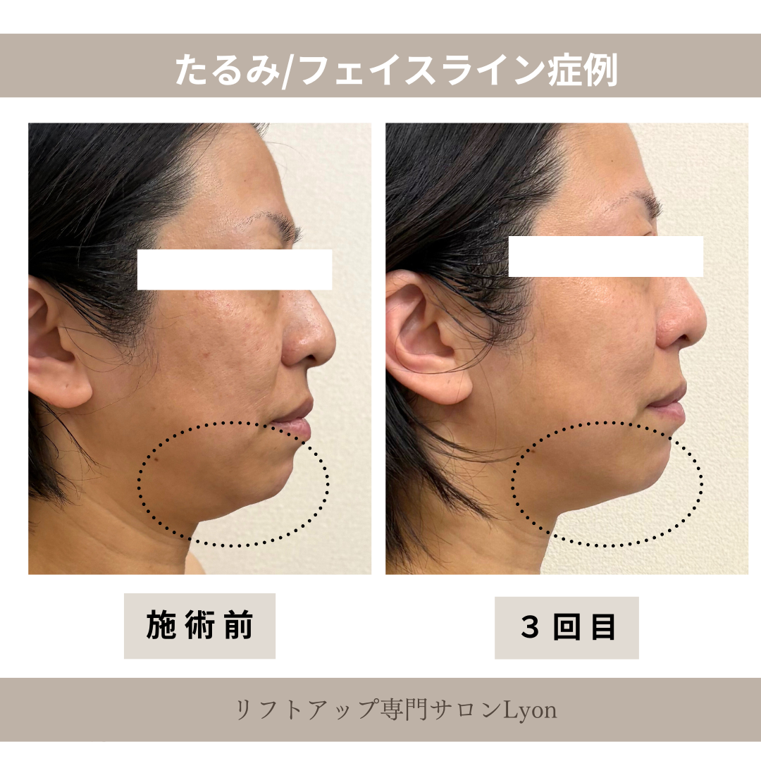 大名・赤坂のリフトアップ専門サロンLyonのブログ/フェイスライン・たるみ②/症例画像
