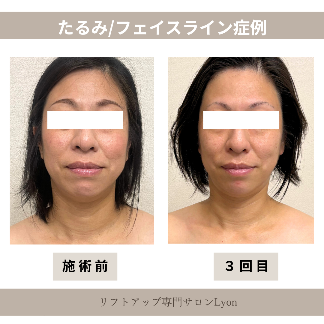 大名・赤坂のリフトアップ専門サロンLyonのブログ/フェイスライン・たるみ①/症例画像