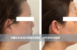 大名・赤坂のリフトアップ専門サロンLyonのブログ/浮腫みの原因/アイキャッチ画像