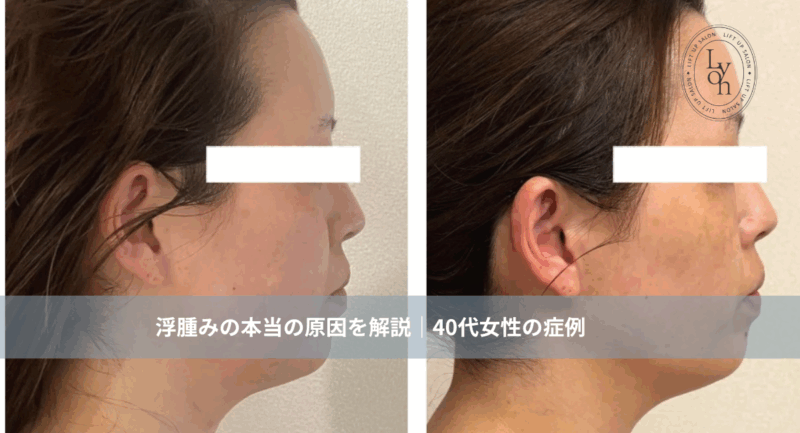 大名・赤坂のリフトアップ専門サロンLyonのブログ/浮腫みの原因/アイキャッチ画像