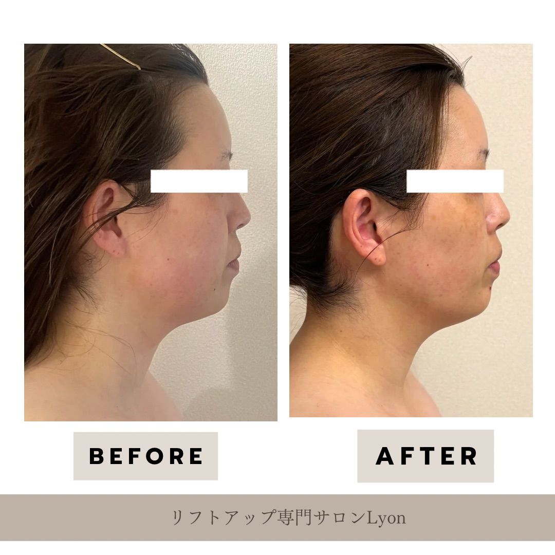 大名・赤坂のリフトアップ専門サロンLyonのブログ/浮腫みの原因/症例画像