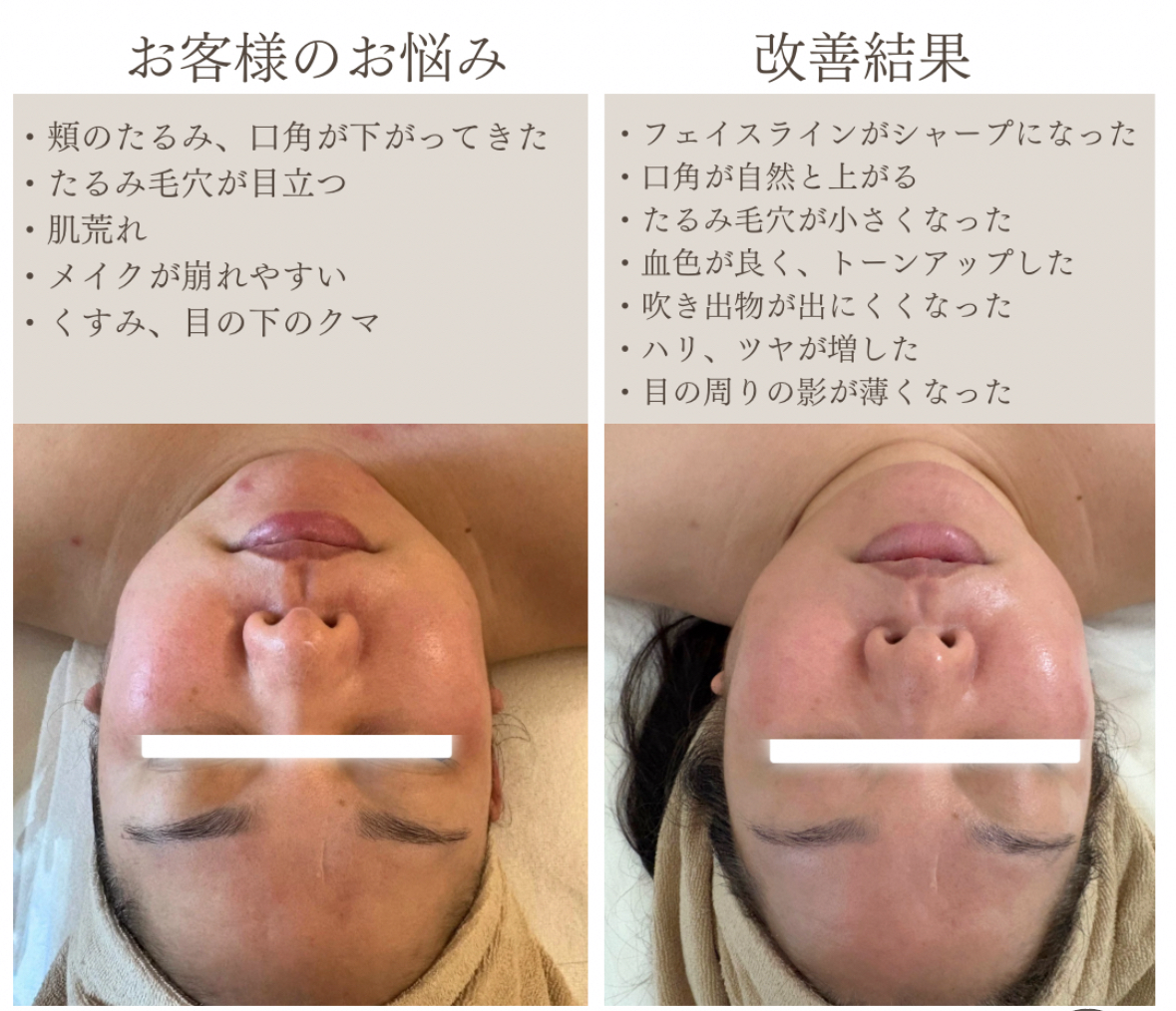 リフトアップフェイシャル、小顔リフトアップ結果写真、ビフォーアフター写真｜リフトアップ専門店リヨン「大名/赤坂/天神」ビフォーアフター写真変化
