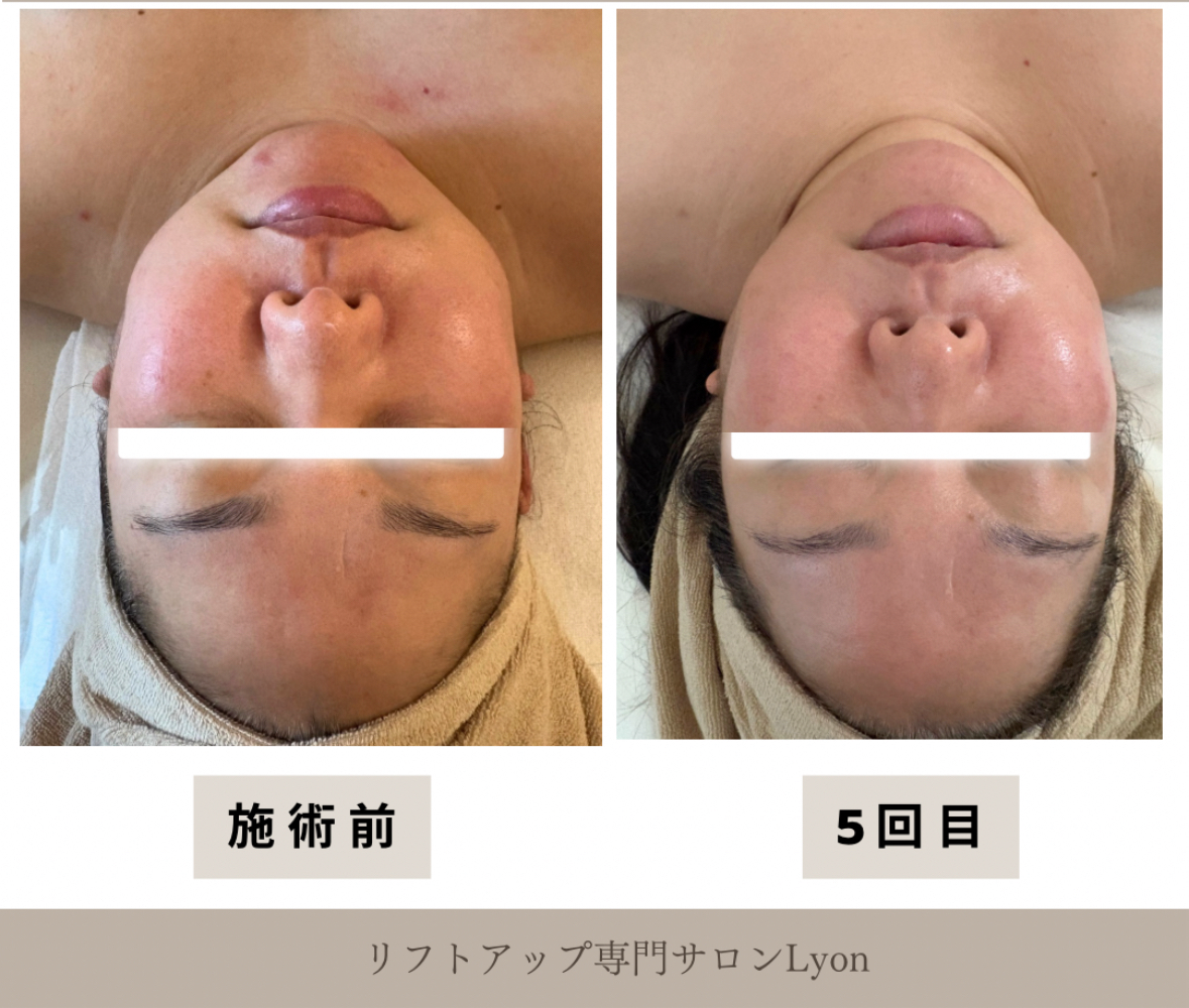 リフトアップフェイシャル、小顔リフトアップ結果写真、ビフォーアフター写真｜リフトアップ専門店リヨン「大名/赤坂/天神」ビフォーアフター写真