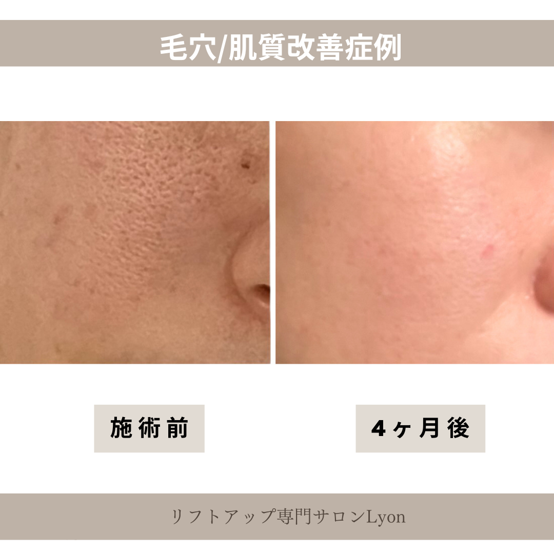 リフトアップフェイシャル、毛穴・肌質改善結果写真、ビフォーアフター写真｜リフトアップ専門店リヨン「大名/赤坂/天神」ビフォーアフター写真