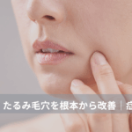 大名・赤坂のリフトアップ専門サロンLyonのブログ/40代・たるみ毛穴根本改善・症例紹介/アイキャッチ画像