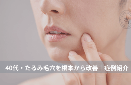 大名・赤坂のリフトアップ専門サロンLyonのブログ/40代・たるみ毛穴根本改善・症例紹介/アイキャッチ画像