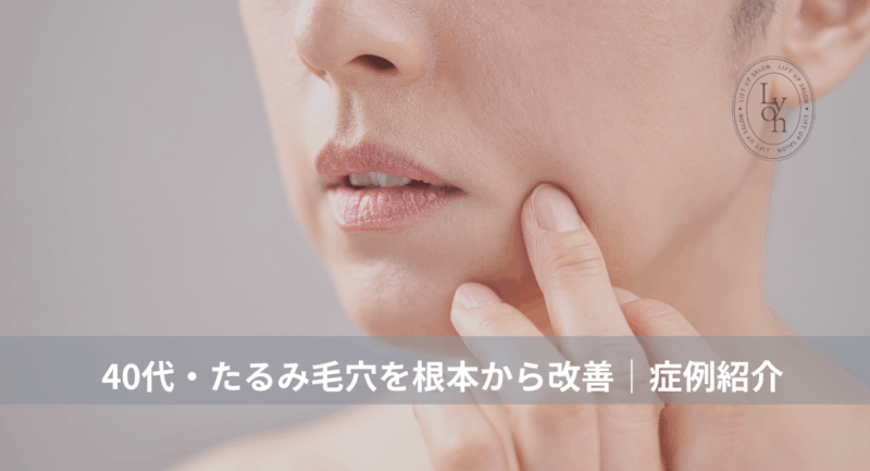 大名・赤坂のリフトアップ専門サロンLyonのブログ/40代・たるみ毛穴根本改善・症例紹介/アイキャッチ画像