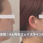 大名・赤坂のリフトアップ専門サロンLyonのブログ/40代・フェイスライン改善・症例紹介/アイキャッチ画像