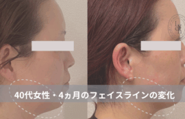 大名・赤坂のリフトアップ専門サロンLyonのブログ/40代・フェイスライン改善・症例紹介/アイキャッチ画像