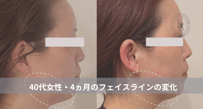 大名・赤坂のリフトアップ専門サロンLyonのブログ/40代・フェイスライン改善・症例紹介/アイキャッチ画像