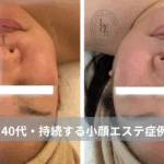 大名・赤坂のリフトアップ専門サロンLyonのブログ/40代・持続する小顔エステ症例｜大名・赤坂・天神Lyon/アイキャッチ画像