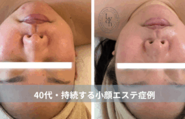 大名・赤坂のリフトアップ専門サロンLyonのブログ/40代・持続する小顔エステ症例｜大名・赤坂・天神Lyon/アイキャッチ画像
