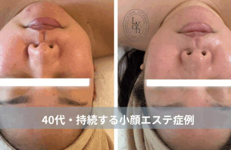 大名・赤坂のリフトアップ専門サロンLyonのブログ/40代・持続する小顔エステ症例｜大名・赤坂・天神Lyon/アイキャッチ画像