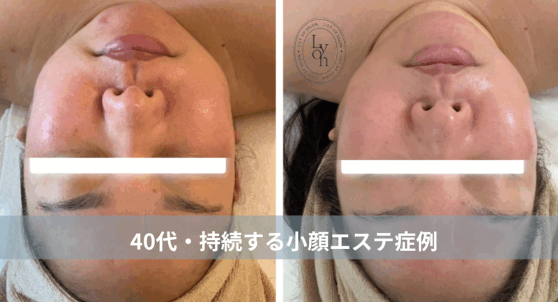 大名・赤坂のリフトアップ専門サロンLyonのブログ/40代・持続する小顔エステ症例｜大名・赤坂・天神Lyon/アイキャッチ画像