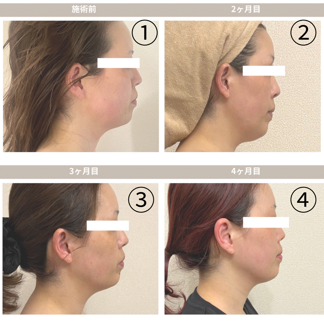 大名・赤坂のリフトアップ専門サロンLyonのブログ/フェイスライン・浮腫み改善変化/症例画像