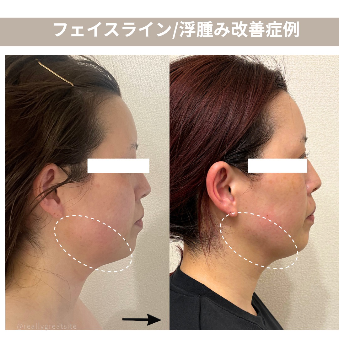大名・赤坂のリフトアップ専門サロンLyonのブログ/フェイスライン・浮腫み改善/症例画像