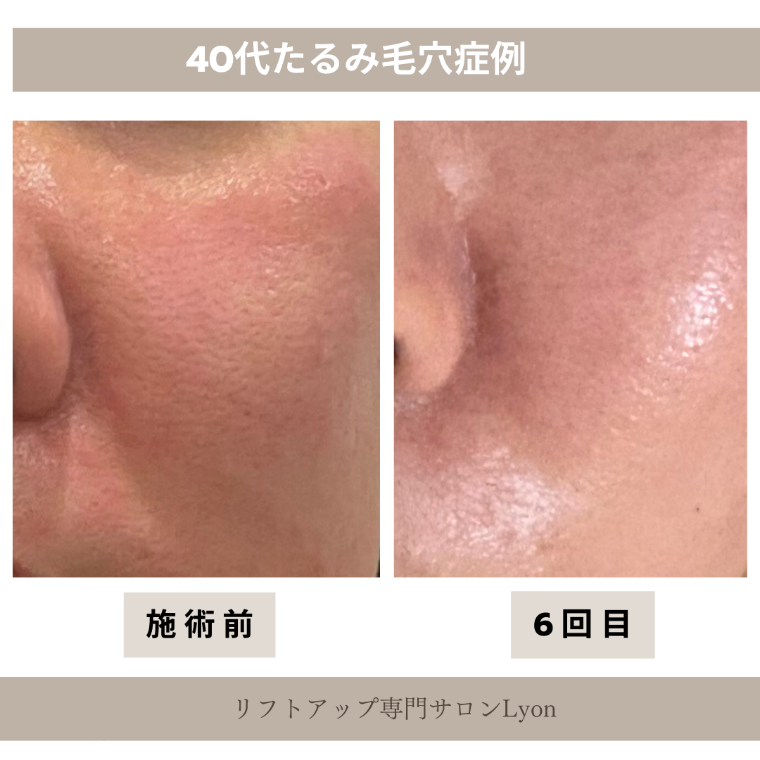 リフトアップフェイシャル、たるみ毛穴結果写真、ビフォーアフター写真|リフトアップ専門店リヨン「大名/赤坂/天神」ビフォーアフター写真