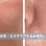 大名・赤坂のリフトアップ専門サロンLyonのブログ/40代・たるみ毛穴改善・症例紹介/アイキャッチ画像