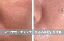 大名・赤坂のリフトアップ専門サロンLyonのブログ/40代・たるみ毛穴改善・症例紹介/アイキャッチ画像