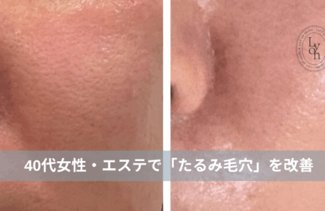 大名・赤坂のリフトアップ専門サロンLyonのブログ/40代・たるみ毛穴改善・症例紹介/アイキャッチ画像