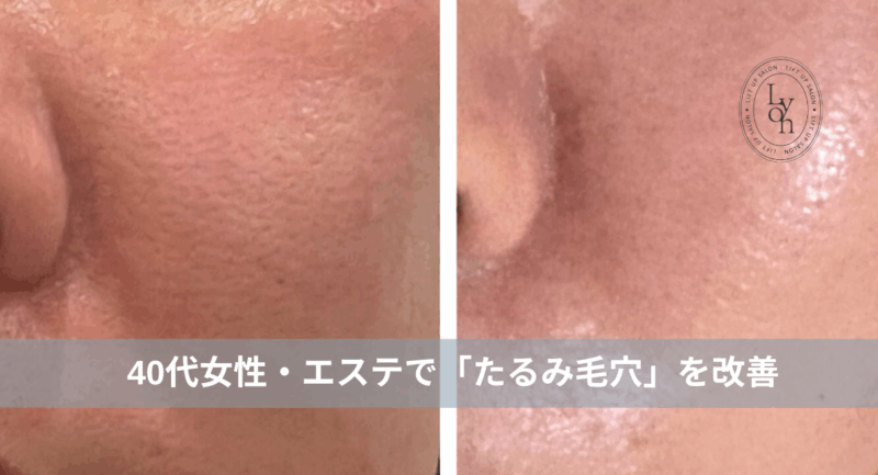 大名・赤坂のリフトアップ専門サロンLyonのブログ/40代・たるみ毛穴改善・症例紹介/アイキャッチ画像