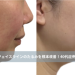 大名・赤坂のリフトアップ専門サロンLyonのブログ/フェイスラインのたるみを根本改善！40代の横顔が変わるリフトアップ ｜大名・天神Lyon/アイキャッチ画像