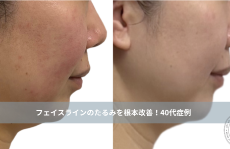 大名・赤坂のリフトアップ専門サロンLyonのブログ/フェイスラインのたるみを根本改善！40代の横顔が変わるリフトアップ ｜大名・天神Lyon/アイキャッチ画像