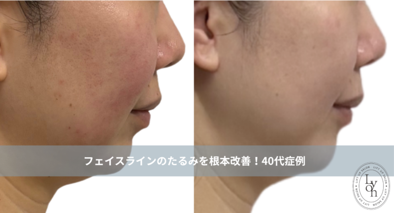 大名・赤坂のリフトアップ専門サロンLyonのブログ/フェイスラインのたるみを根本改善！40代の横顔が変わるリフトアップ ｜大名・天神Lyon/アイキャッチ画像
