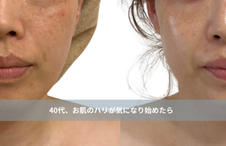 大名・赤坂のリフトアップ専門サロンLyonのブログ /【40代、肌のハリが気になり始めたら】内側からふっくら弾むツヤ肌を作るエステ｜大名・天神エステ/アイキャッチ画像