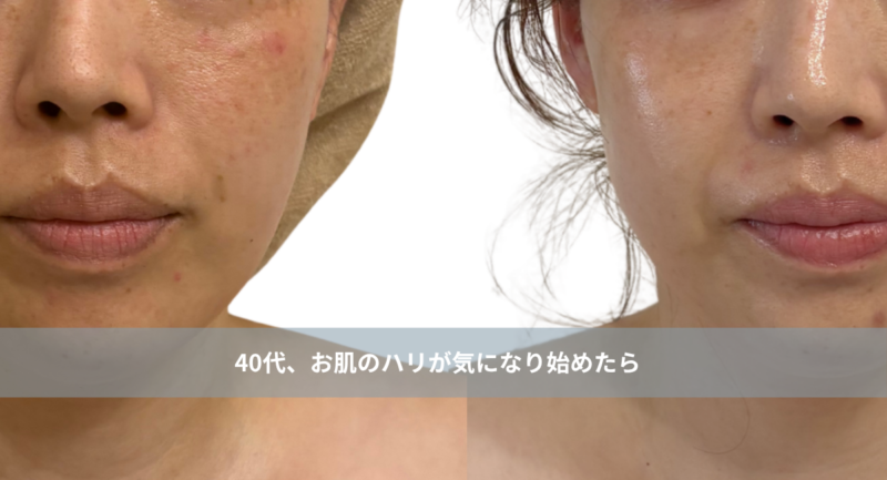 大名・赤坂のリフトアップ専門サロンLyonのブログ /【40代、肌のハリが気になり始めたら】内側からふっくら弾むツヤ肌を作るエステ｜大名・天神エステ/アイキャッチ画像
