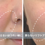 大名・赤坂のリフトアップ専門サロンLyonのブログ /【大名・天神エステ】「ほうれい線が深くなった…」40代の消えないほうれい線に、戻らないリフトアップエステ/アイキャッチ画像