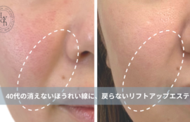 大名・赤坂のリフトアップ専門サロンLyonのブログ /【大名・天神エステ】「ほうれい線が深くなった…」40代の消えないほうれい線に、戻らないリフトアップエステ/アイキャッチ画像