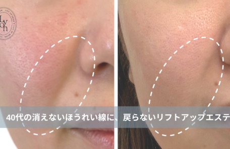 大名・赤坂のリフトアップ専門サロンLyonのブログ /【大名・天神エステ】「ほうれい線が深くなった…」40代の消えないほうれい線に、戻らないリフトアップエステ/アイキャッチ画像