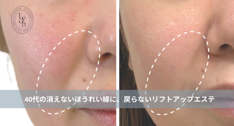大名・赤坂のリフトアップ専門サロンLyonのブログ /【大名・天神エステ】「ほうれい線が深くなった…」40代の消えないほうれい線に、戻らないリフトアップエステ/アイキャッチ画像