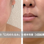 大名・赤坂のリフトアップ専門サロンLyonのブログ/天神・大名エステ｜40代の「口元のたるみ」を根本改善【5回結果写真】｜天神・大名のエステ/アイキャッチ画像