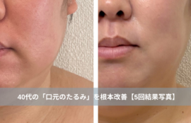 大名・赤坂のリフトアップ専門サロンLyonのブログ/天神・大名エステ｜40代の「口元のたるみ」を根本改善【5回結果写真】｜天神・大名のエステ/アイキャッチ画像