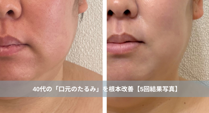 大名・赤坂のリフトアップ専門サロンLyonのブログ/天神・大名エステ｜40代の「口元のたるみ」を根本改善【5回結果写真】｜天神・大名のエステ/アイキャッチ画像